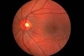 Retina